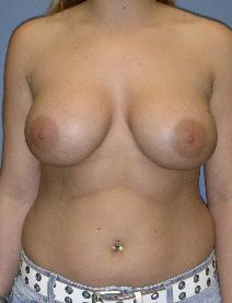 Breast Augmentation After Photo by James Lowe, MD; Oklahoma City, OK - Case 6761