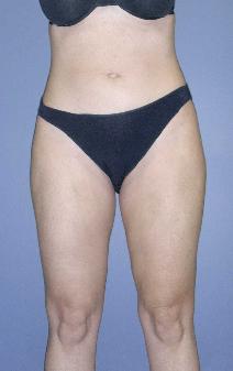 Liposuction After Photo by James Lowe, MD; Oklahoma City, OK - Case 6763