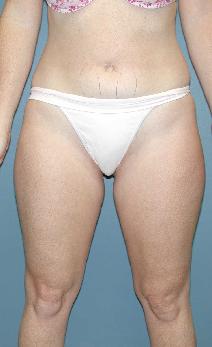 Liposuction Before Photo by James Lowe, MD; Oklahoma City, OK - Case 6763