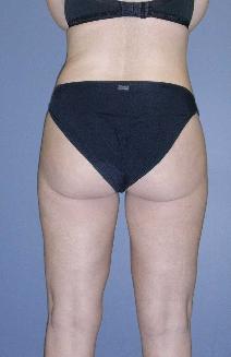 Liposuction After Photo by James Lowe, MD; Oklahoma City, OK - Case 6763