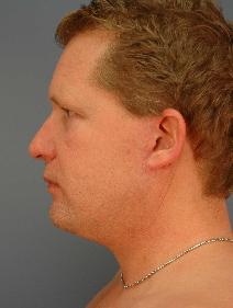 Facelift After Photo by James Lowe, MD; Oklahoma City, OK - Case 6765