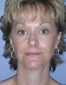 Eyelid Surgery After Photo by James Lowe, MD; Oklahoma City, OK - Case 6773