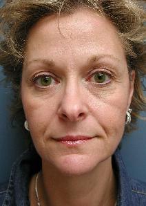 Eyelid Surgery Before Photo by James Lowe, MD; Oklahoma City, OK - Case 6773
