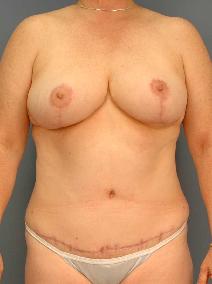 Breast Reduction After Photo by James Lowe, MD; Oklahoma City, OK - Case 6776