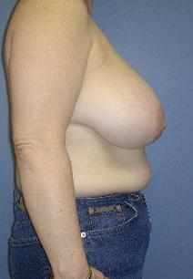 Breast Reduction Before Photo by James Lowe, MD; Oklahoma City, OK - Case 6776