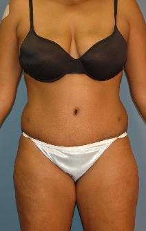 Tummy Tuck After Photo by James Lowe, MD; Oklahoma City, OK - Case 6777