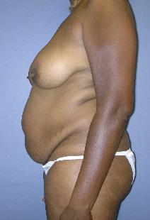 Tummy Tuck Before Photo by James Lowe, MD; Oklahoma City, OK - Case 6777