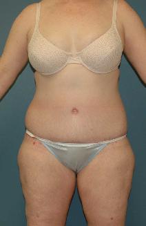 Tummy Tuck After Photo by James Lowe, MD; Oklahoma City, OK - Case 6778