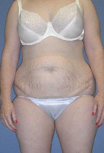 Tummy Tuck Before Photo by James Lowe, MD; Oklahoma City, OK - Case 6778