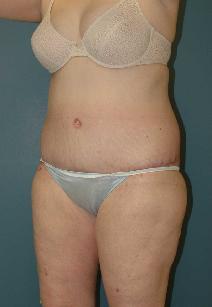 Tummy Tuck After Photo by James Lowe, MD; Oklahoma City, OK - Case 6778