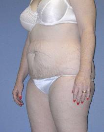 Tummy Tuck Before Photo by James Lowe, MD; Oklahoma City, OK - Case 6778