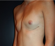 Breast Augmentation Before Photo by Larry Weinstein, MD; Chester, NJ - Case 24761