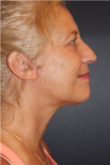 Facelift After Photo by Larry Weinstein, MD; Chester, NJ - Case 30655