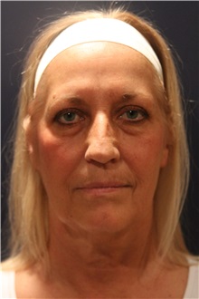 Facelift Before Photo by Larry Weinstein, MD; Chester, NJ - Case 30655