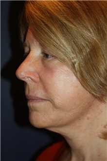 Facelift After Photo by Larry Weinstein, MD; Chester, NJ - Case 30656