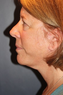 Facelift After Photo by Larry Weinstein, MD; Chester, NJ - Case 30656