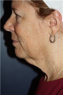 Facelift Before Photo by Larry Weinstein, MD; Chester, NJ - Case 30656