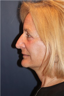 Facelift After Photo by Larry Weinstein, MD; Chester, NJ - Case 30657