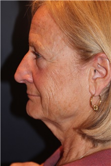 Facelift Before Photo by Larry Weinstein, MD; Chester, NJ - Case 30657