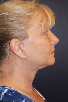 Facelift After Photo by Larry Weinstein, MD; Chester, NJ - Case 30661