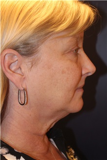 Facelift Before Photo by Larry Weinstein, MD; Chester, NJ - Case 30661