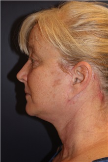 Facelift After Photo by Larry Weinstein, MD; Chester, NJ - Case 30661