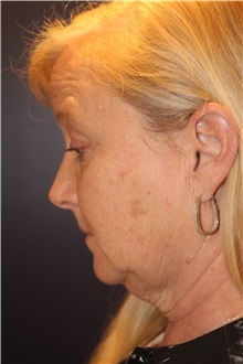 Facelift Before Photo by Larry Weinstein, MD; Chester, NJ - Case 30661