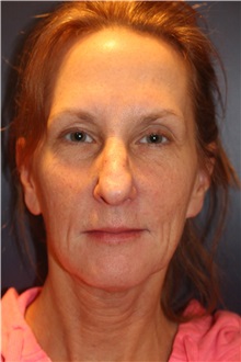 Facelift Before Photo by Larry Weinstein, MD; Chester, NJ - Case 30663