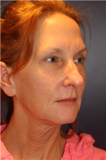 Facelift Before Photo by Larry Weinstein, MD; Chester, NJ - Case 30663