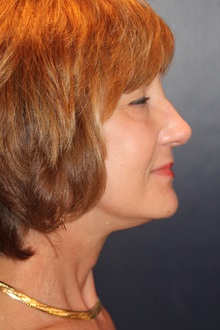 Facelift After Photo by Larry Weinstein, MD; Chester, NJ - Case 30664