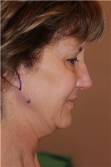 Facelift Before Photo by Larry Weinstein, MD; Chester, NJ - Case 30664