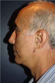 Facelift After Photo by Larry Weinstein, MD; Chester, NJ - Case 31709