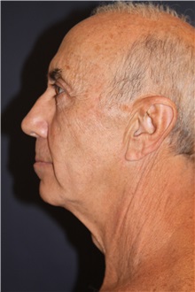 Facelift Before Photo by Larry Weinstein, MD; Chester, NJ - Case 31709