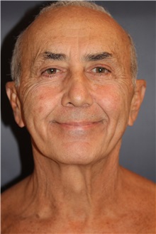 Facelift Before Photo by Larry Weinstein, MD; Chester, NJ - Case 31709