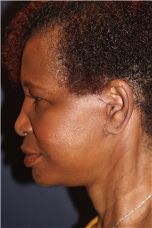 Facelift After Photo by Larry Weinstein, MD; Chester, NJ - Case 31761