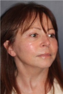 Facelift After Photo by Larry Weinstein, MD; Chester, NJ - Case 31762