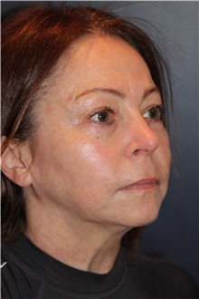 Facelift Before Photo by Larry Weinstein, MD; Chester, NJ - Case 31762