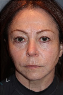 Facelift Before Photo by Larry Weinstein, MD; Chester, NJ - Case 31762