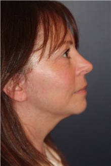 Facelift After Photo by Larry Weinstein, MD; Chester, NJ - Case 31762