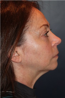 Facelift Before Photo by Larry Weinstein, MD; Chester, NJ - Case 31762