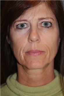 Facelift Before Photo by Larry Weinstein, MD; Chester, NJ - Case 31779