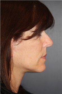 Facelift After Photo by Larry Weinstein, MD; Chester, NJ - Case 31779