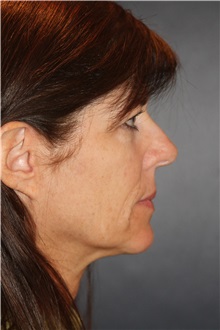 Facelift Before Photo by Larry Weinstein, MD; Chester, NJ - Case 31779