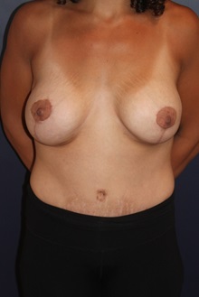 Tummy Tuck After Photo by Larry Weinstein, MD; Chester, NJ - Case 31889