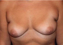 Breast Augmentation Before Photo by Larry Weinstein, MD; Chester, NJ - Case 31904