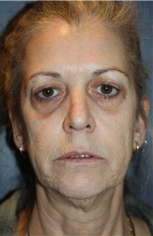 Facelift Before Photo by Larry Weinstein, MD; Chester, NJ - Case 31920