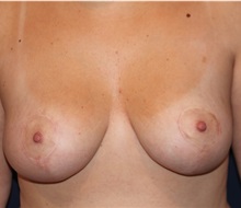 Breast Lift After Photo by Larry Weinstein, MD; Chester, NJ - Case 31922