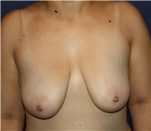 Breast Lift Before Photo by Larry Weinstein, MD; Chester, NJ - Case 31922