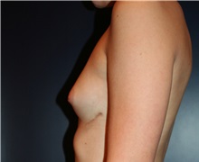 Breast Augmentation Before Photo by Larry Weinstein, MD; Chester, NJ - Case 31924
