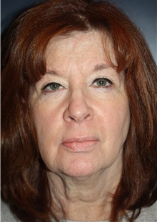 Facelift Before Photo by Larry Weinstein, MD; Chester, NJ - Case 31926